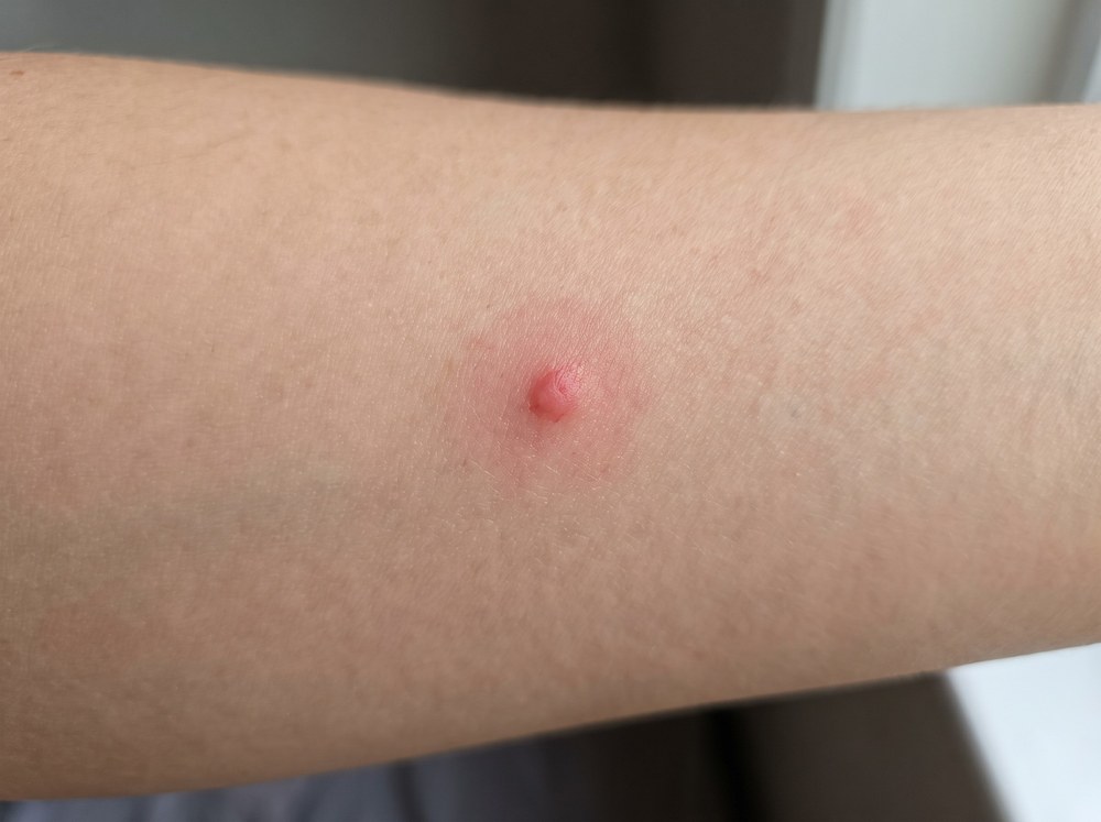 Close-up of a fresh woodlouse spider bite showing two small puncture marks with mild surrounding redness and no blistering